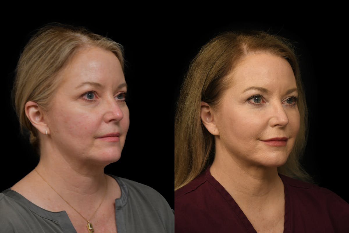 Neck Lift Before & After Gallery - Patient 414888 - Image 3