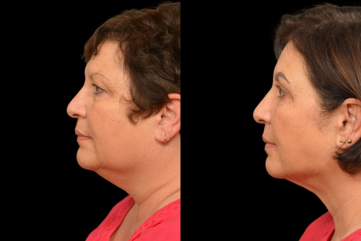 Neck Lift Before & After Gallery - Patient 322652 - Image 2