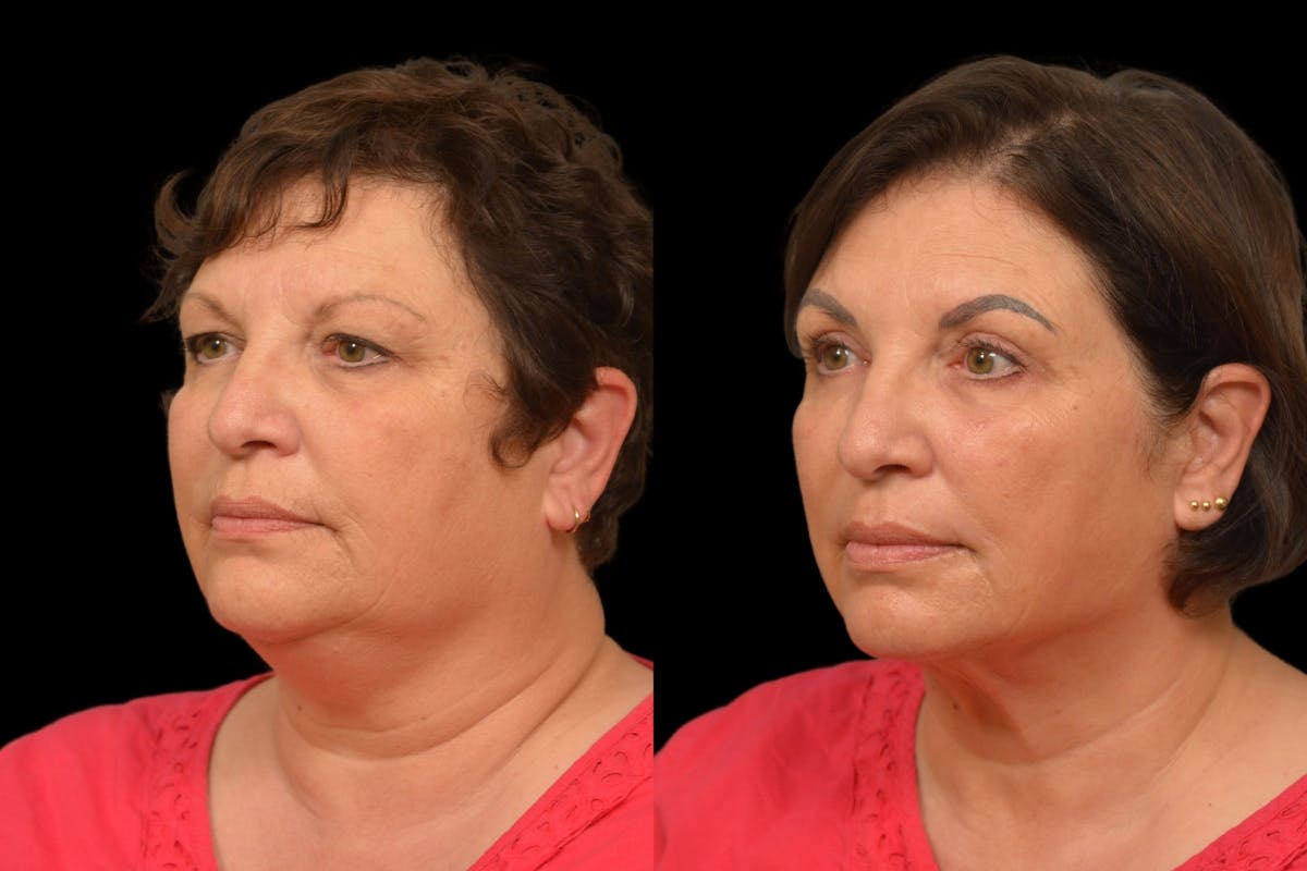 Neck Lift Before & After Gallery - Patient 322652 - Image 1