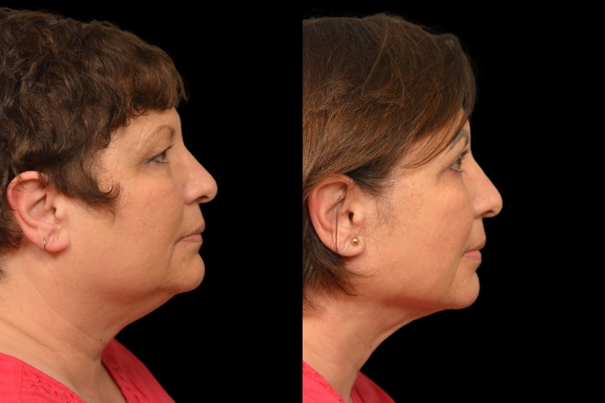Neck Lift Before & After Gallery - Patient 322652 - Image 3