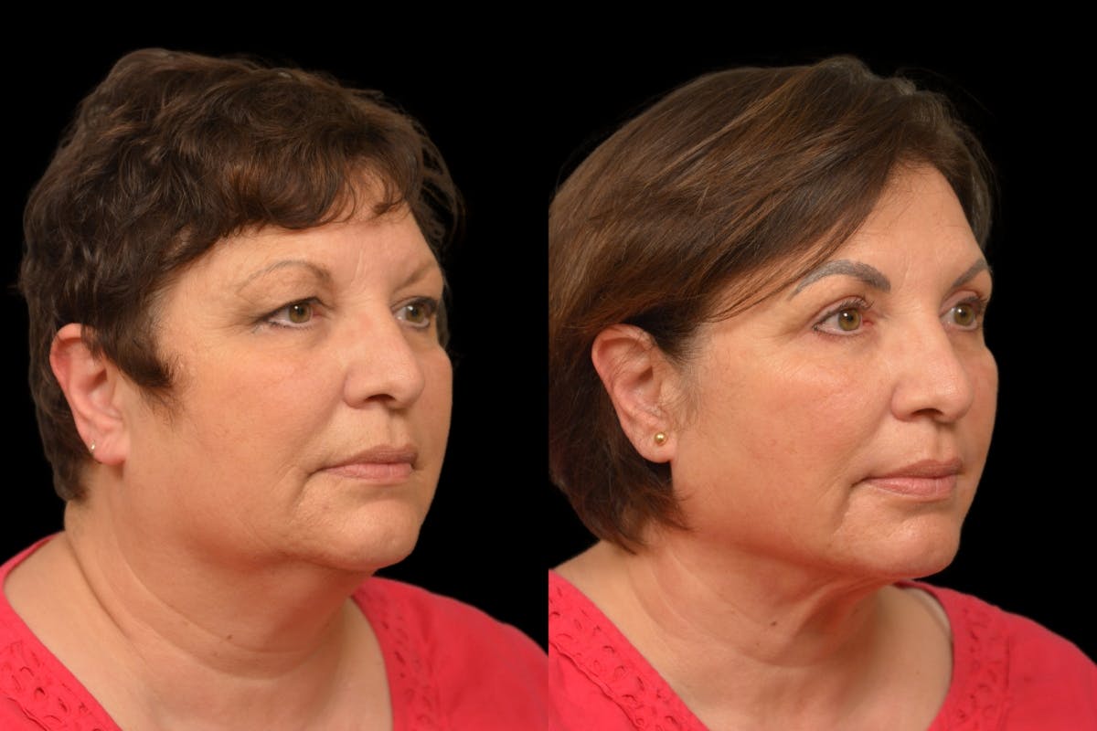 Neck Lift Before & After Gallery - Patient 322652 - Image 4