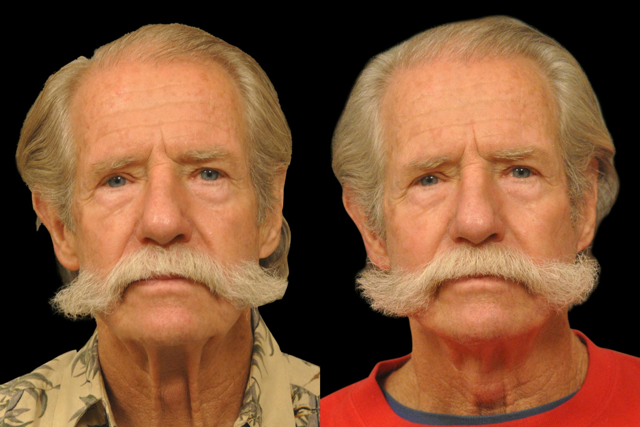 Changes Rapid Lift  Before & After Gallery - Patient 925514 - Image 5