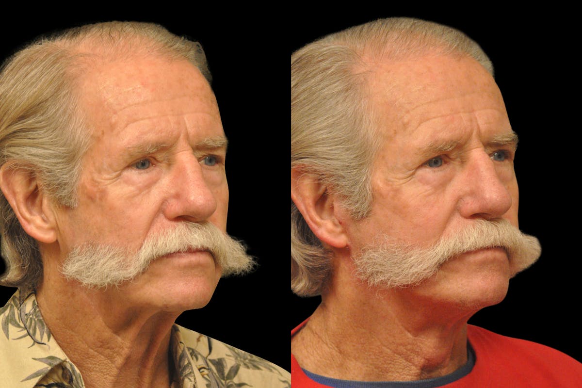 Changes Rapid Lift  Before & After Gallery - Patient 925514 - Image 4