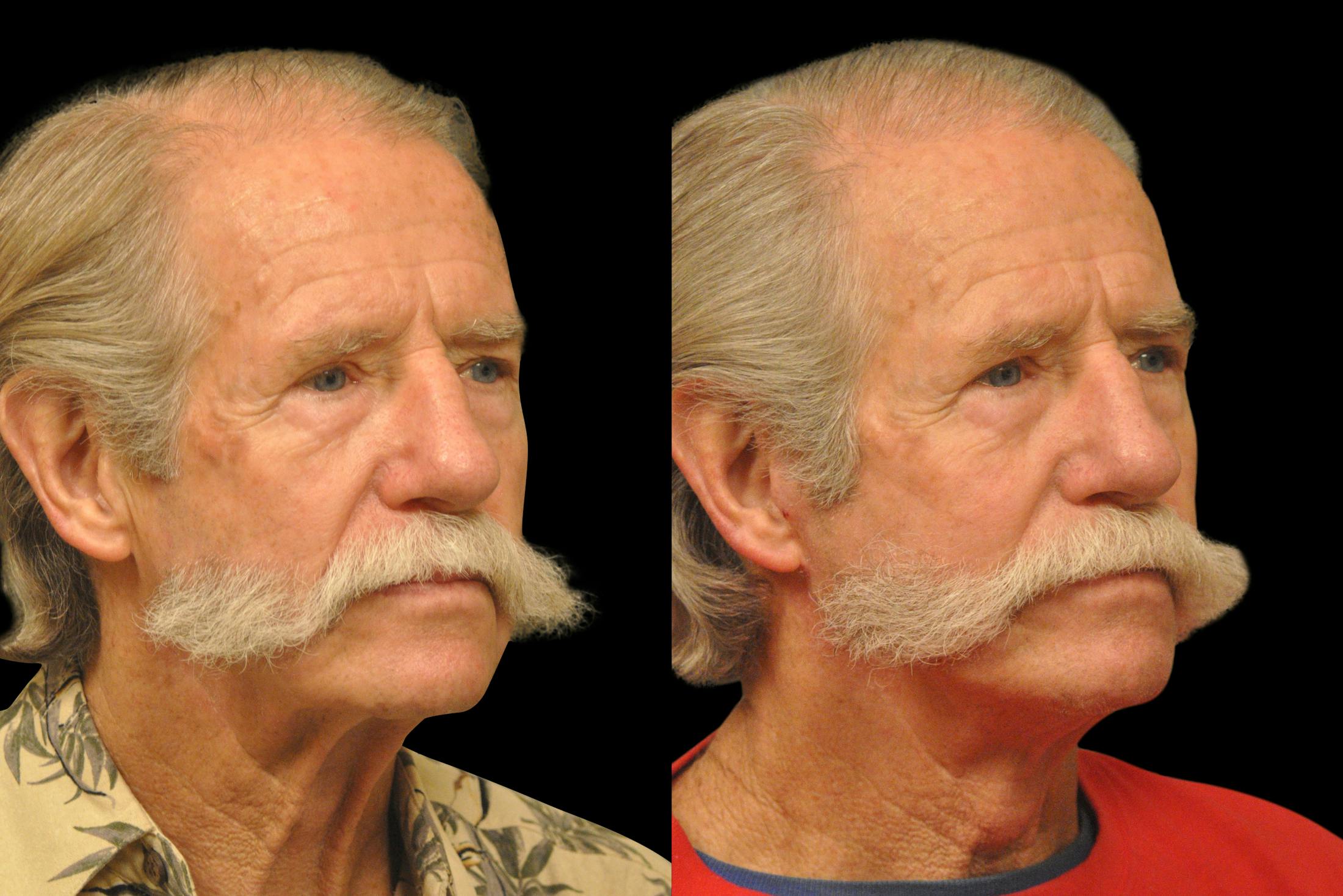 Changes Rapid Lift  Before & After Gallery - Patient 925514 - Image 4