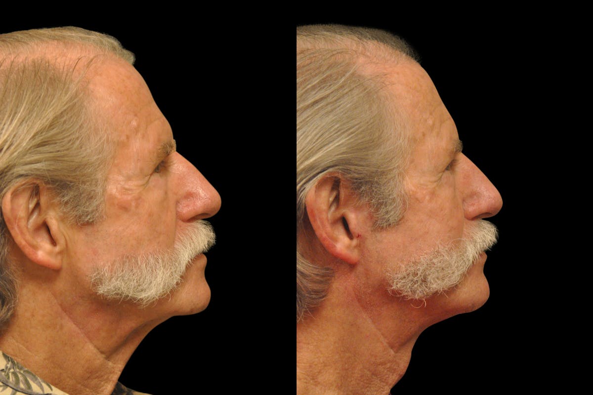 Changes Rapid Lift  Before & After Gallery - Patient 925514 - Image 3