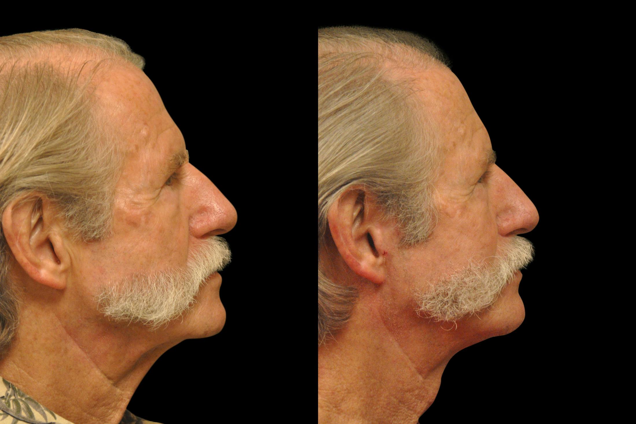 Changes Rapid Lift  Before & After Gallery - Patient 925514 - Image 3