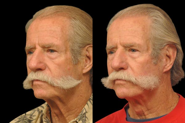 Changes Rapid Lift  Before & After Gallery - Patient 925514 - Image 1