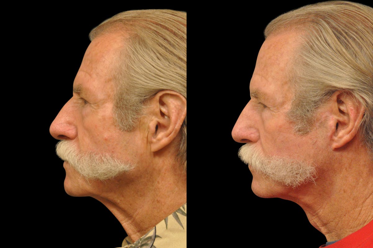Changes Rapid Lift  Before & After Gallery - Patient 925514 - Image 2