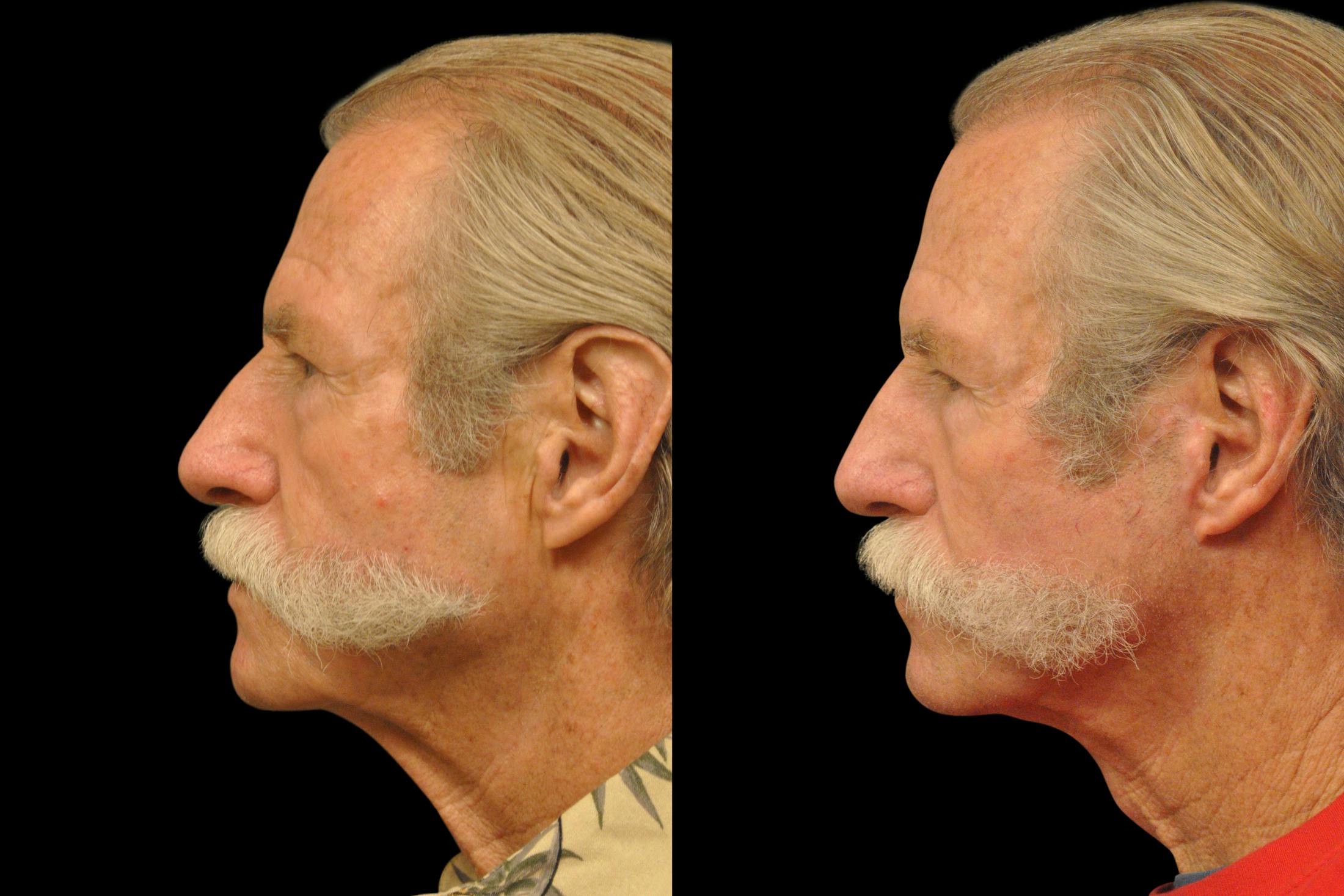 Changes Rapid Lift  Before & After Gallery - Patient 925514 - Image 2