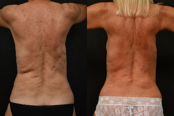 Scarless Scar Revision Before & After Gallery - Patient 148416 - Image 1