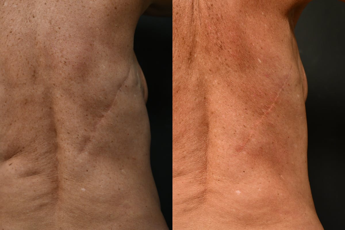 Scarless Scar Revision Before & After Gallery - Patient 148416 - Image 2
