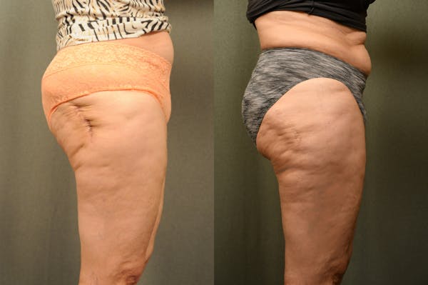 Scarless Scar Revision Before & After Gallery - Patient 208756 - Image 1