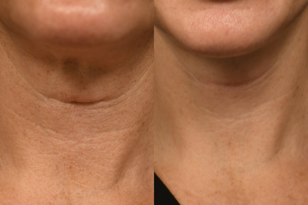 Scarless Scar Revision Before & After Gallery - Patient 788805 - Image 2
