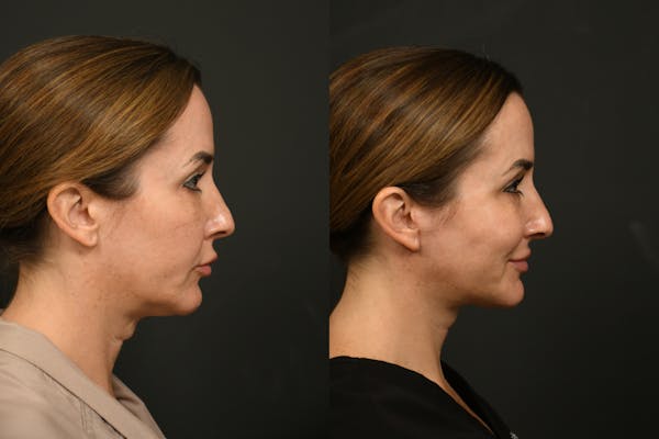 Scarless Scar Revision Before & After Gallery - Patient 788805 - Image 1