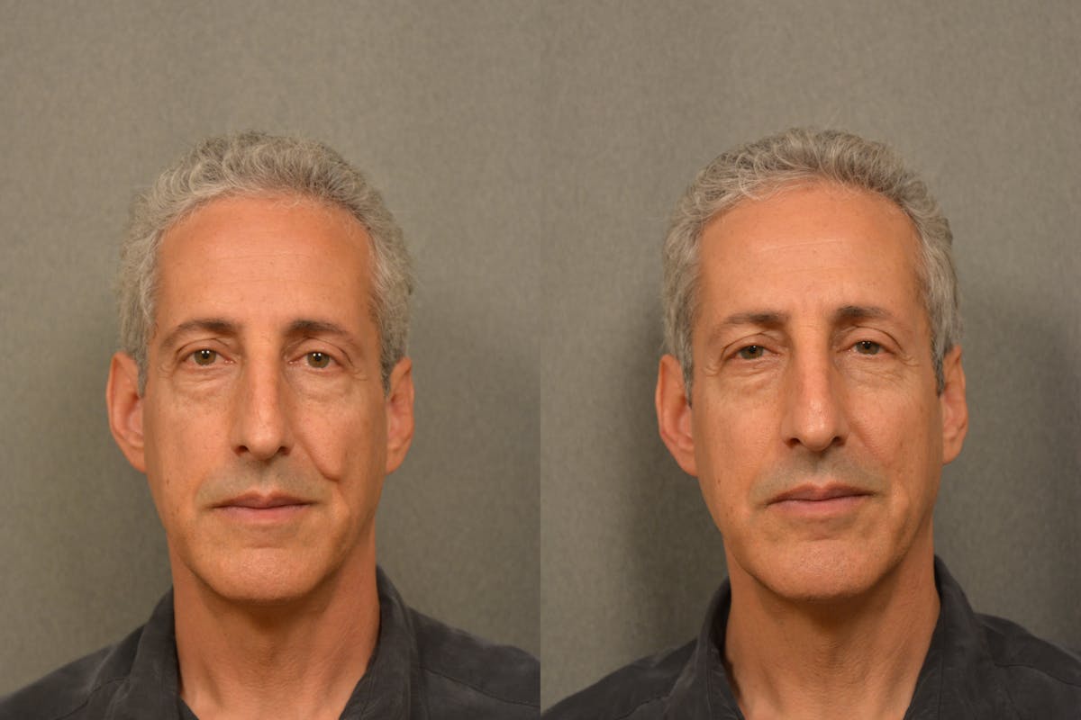Scarless Scar Revision Before & After Gallery - Patient 378557 - Image 1