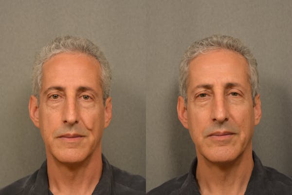 Scarless Scar Revision Before & After Gallery - Patient 378557 - Image 1