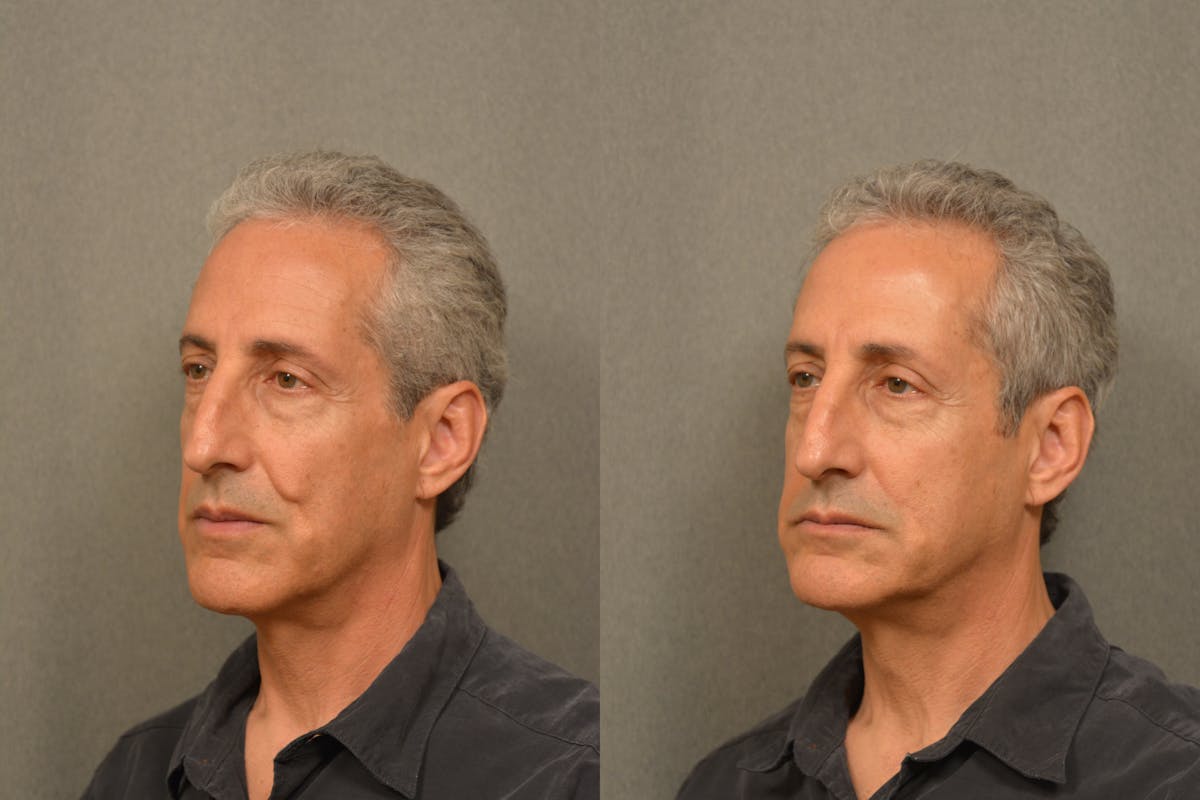 Scarless Scar Revision Before & After Gallery - Patient 378557 - Image 2