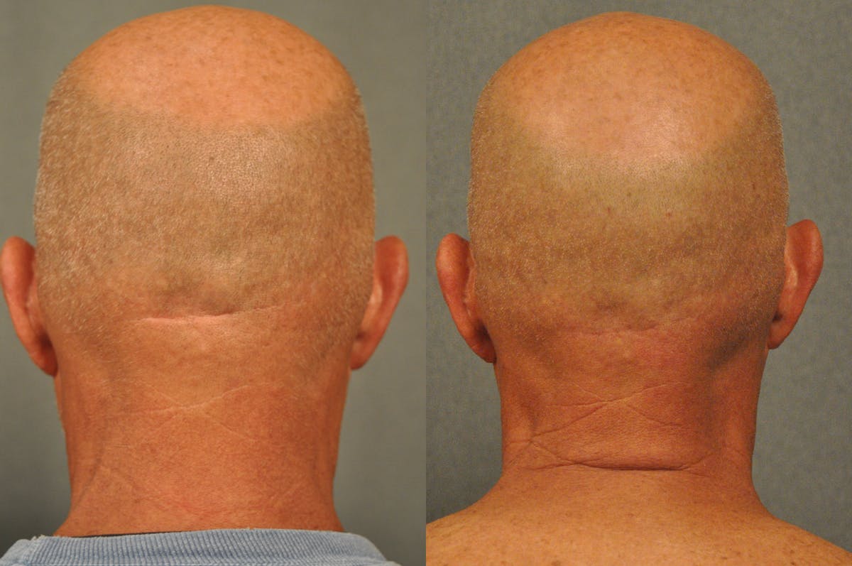 Scarless Scar Revision Before & After Gallery - Patient 831689 - Image 1
