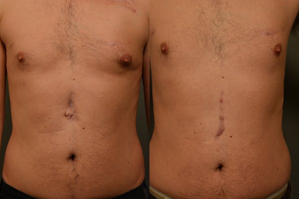 Scarless Scar Revision Before & After Gallery - Patient 568642 - Image 1