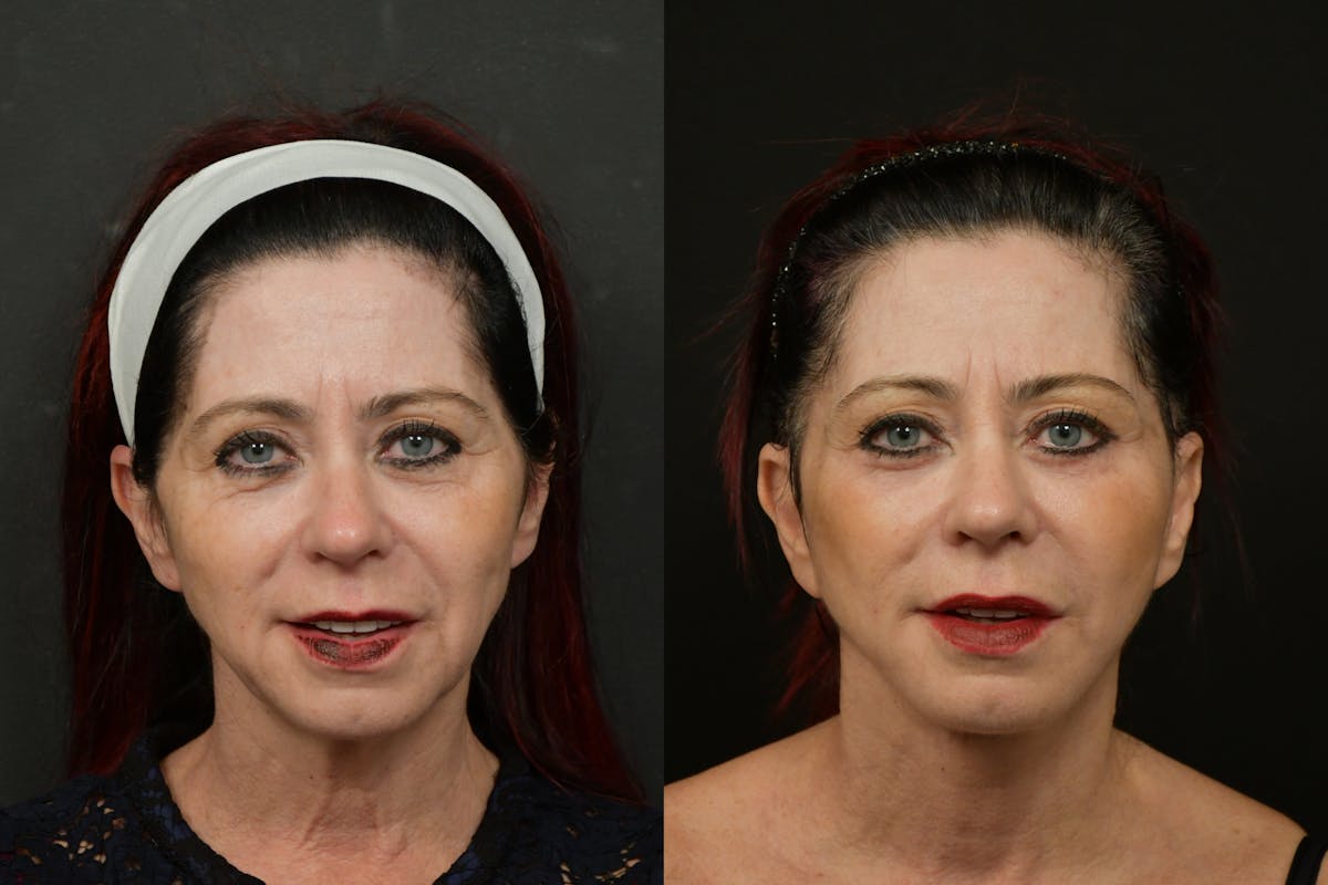Changes Rapid Lift  Before & After Gallery - Patient 313624 - Image 5