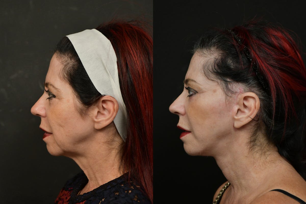 Changes Rapid Lift  Before & After Gallery - Patient 313624 - Image 2