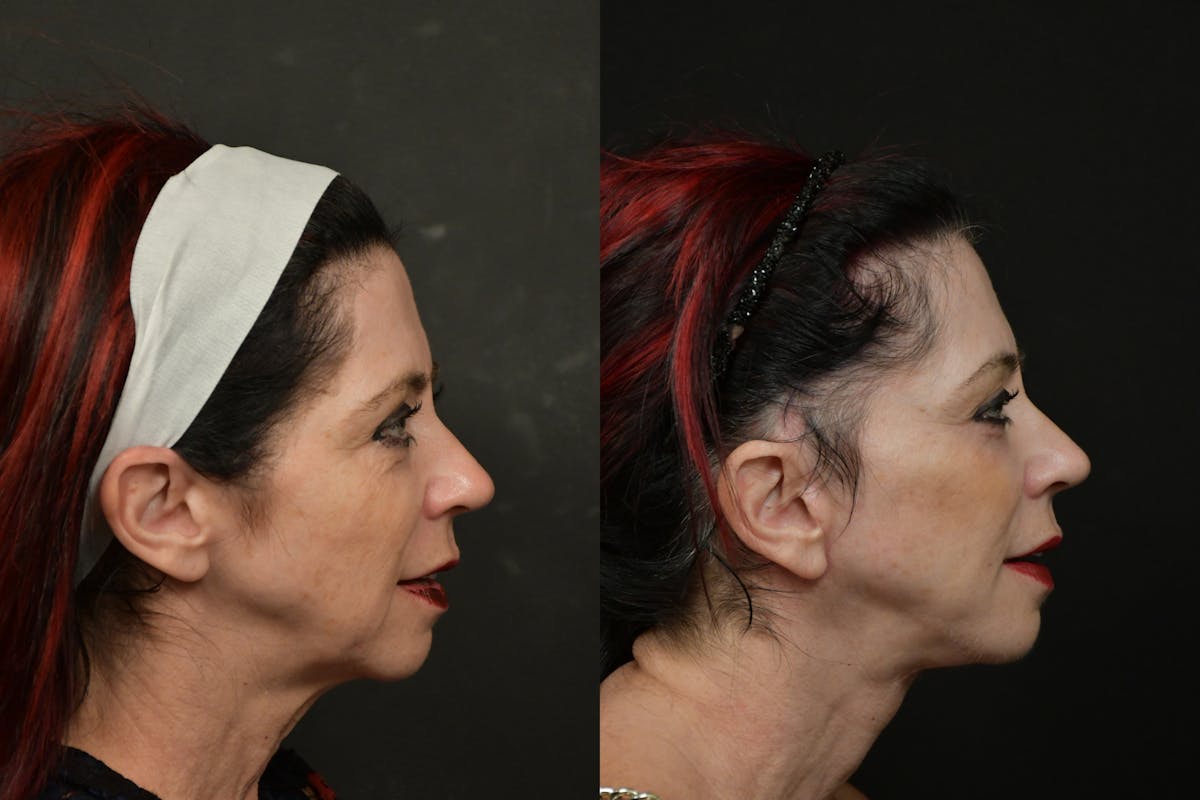 Changes Rapid Lift  Before & After Gallery - Patient 313624 - Image 4