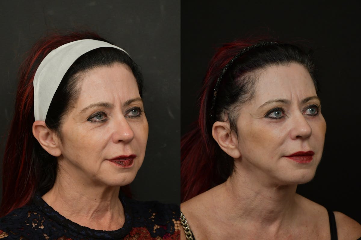 Changes Rapid Lift  Before & After Gallery - Patient 313624 - Image 3