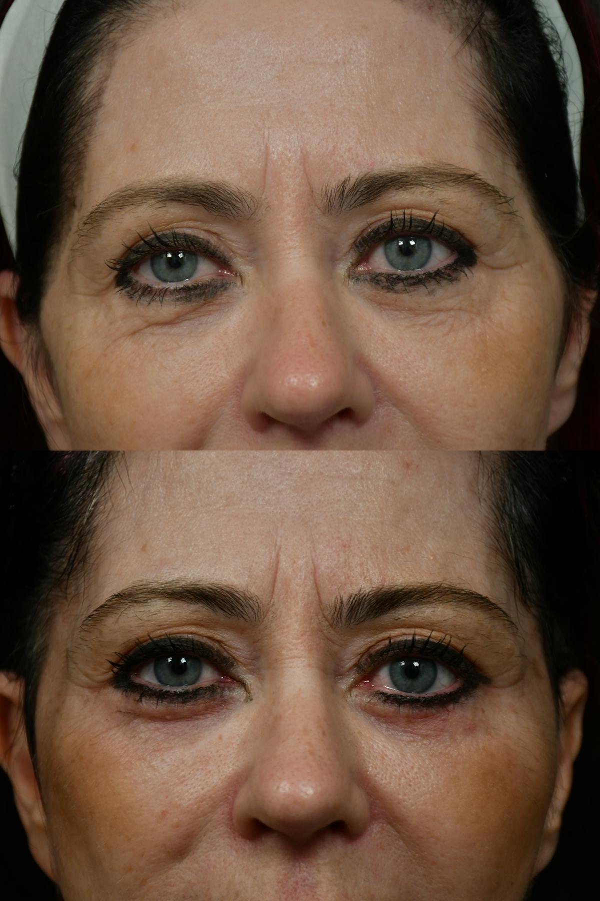 Changes Rapid Lift  Before & After Gallery - Patient 313624 - Image 6