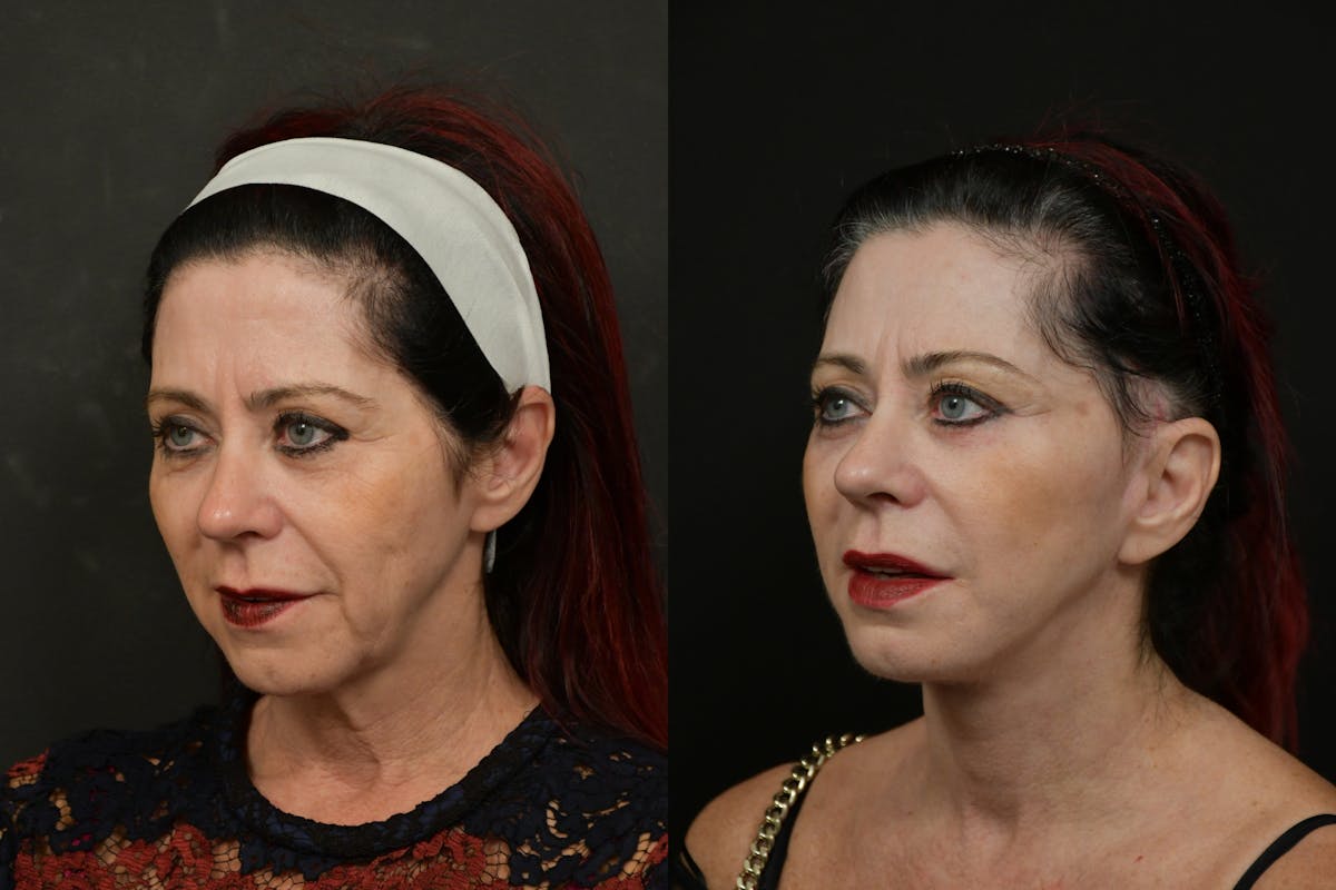 Changes Rapid Lift  Before & After Gallery - Patient 313624 - Image 1