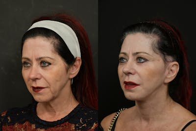 Changes Rapid Lift  Before & After Gallery - Patient 313624 - Image 1