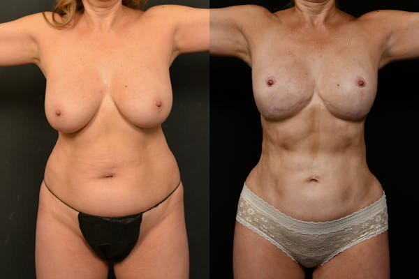 Liposuction / BodyTite Before & After Gallery - Patient 124858 - Image 1