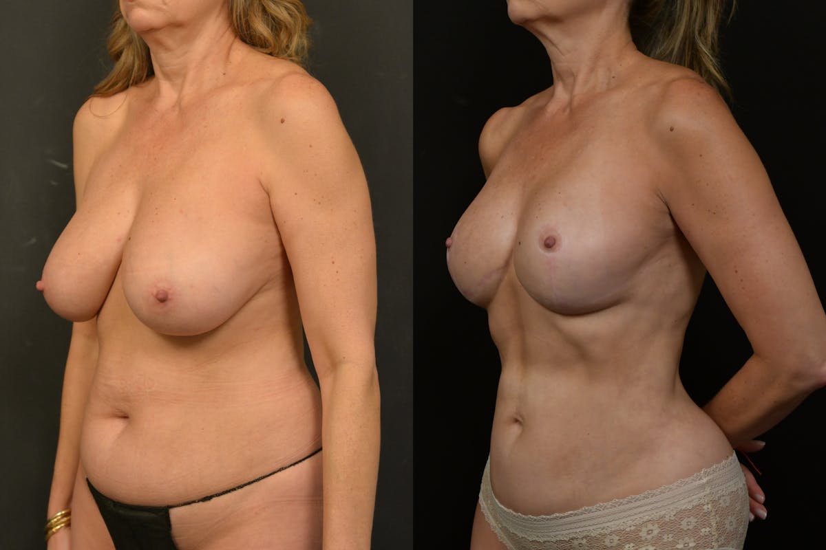 Breast Reduction Before & After Gallery - Patient 251748 - Image 4