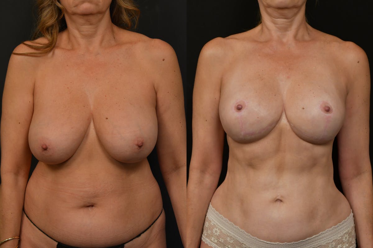 Breast Reduction Before & After Gallery - Patient 251748 - Image 1