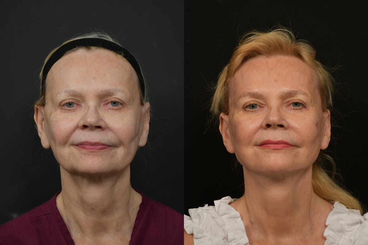 Changes Rapid Lift  Before & After Gallery - Patient 412989 - Image 5