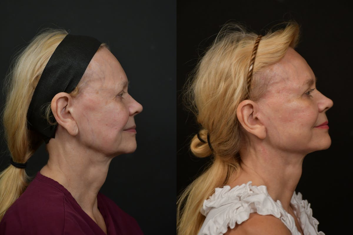 Changes Rapid Lift  Before & After Gallery - Patient 412989 - Image 4