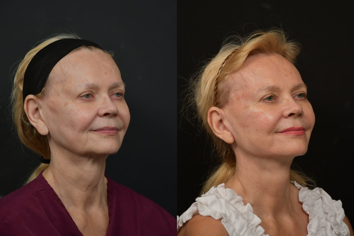 Changes Rapid Lift  Before & After Gallery - Patient 412989 - Image 3