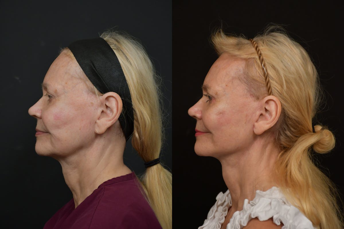 Changes Rapid Lift  Before & After Gallery - Patient 412989 - Image 2