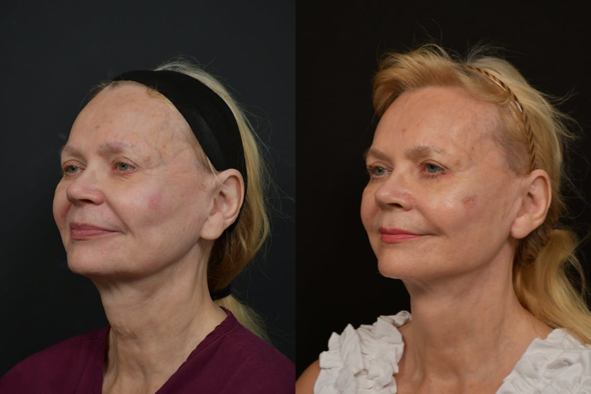 Changes Rapid Lift  Before & After Gallery - Patient 412989 - Image 1