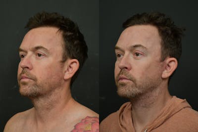 Changes Rapid Lift  Before & After Gallery - Patient 906278 - Image 1
