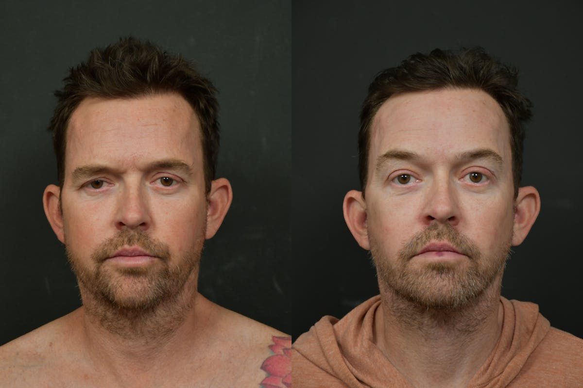 Changes Rapid Lift For Men Before & After Gallery - Patient 262467 - Image 5