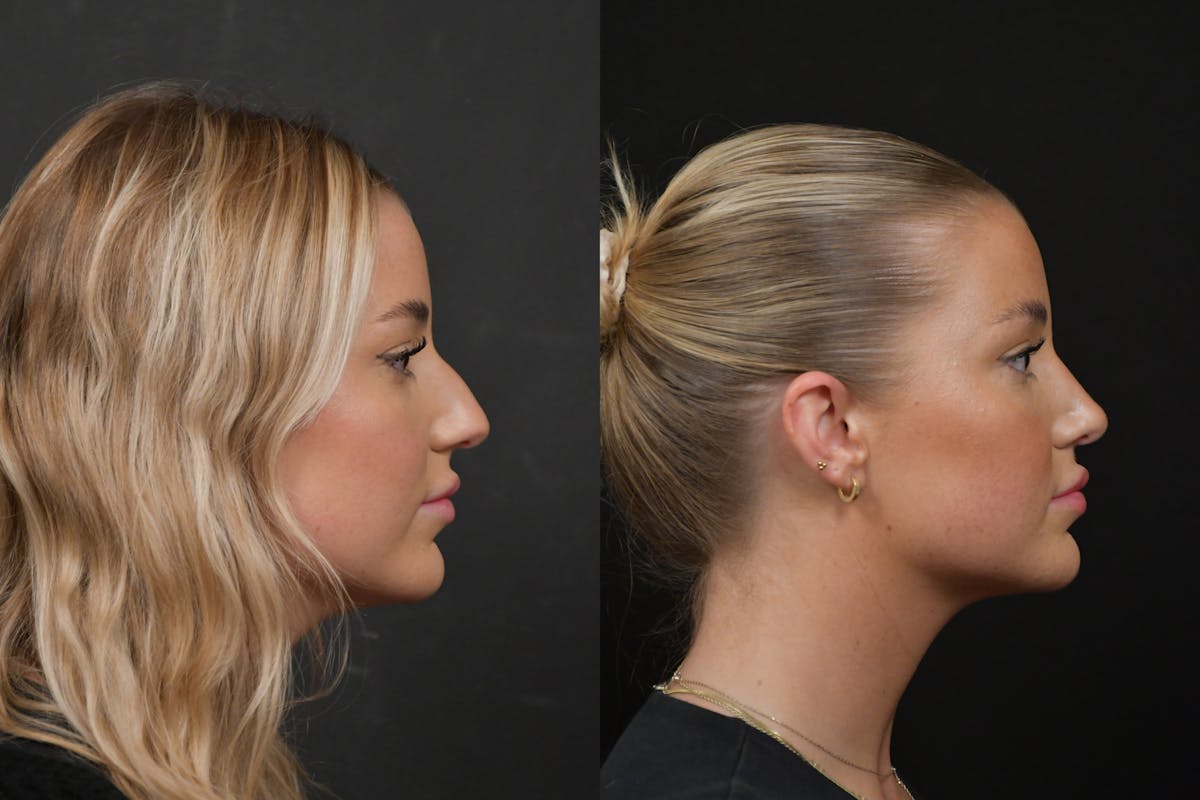 Rhinoplasty Before & After Gallery - Patient 317118 - Image 4