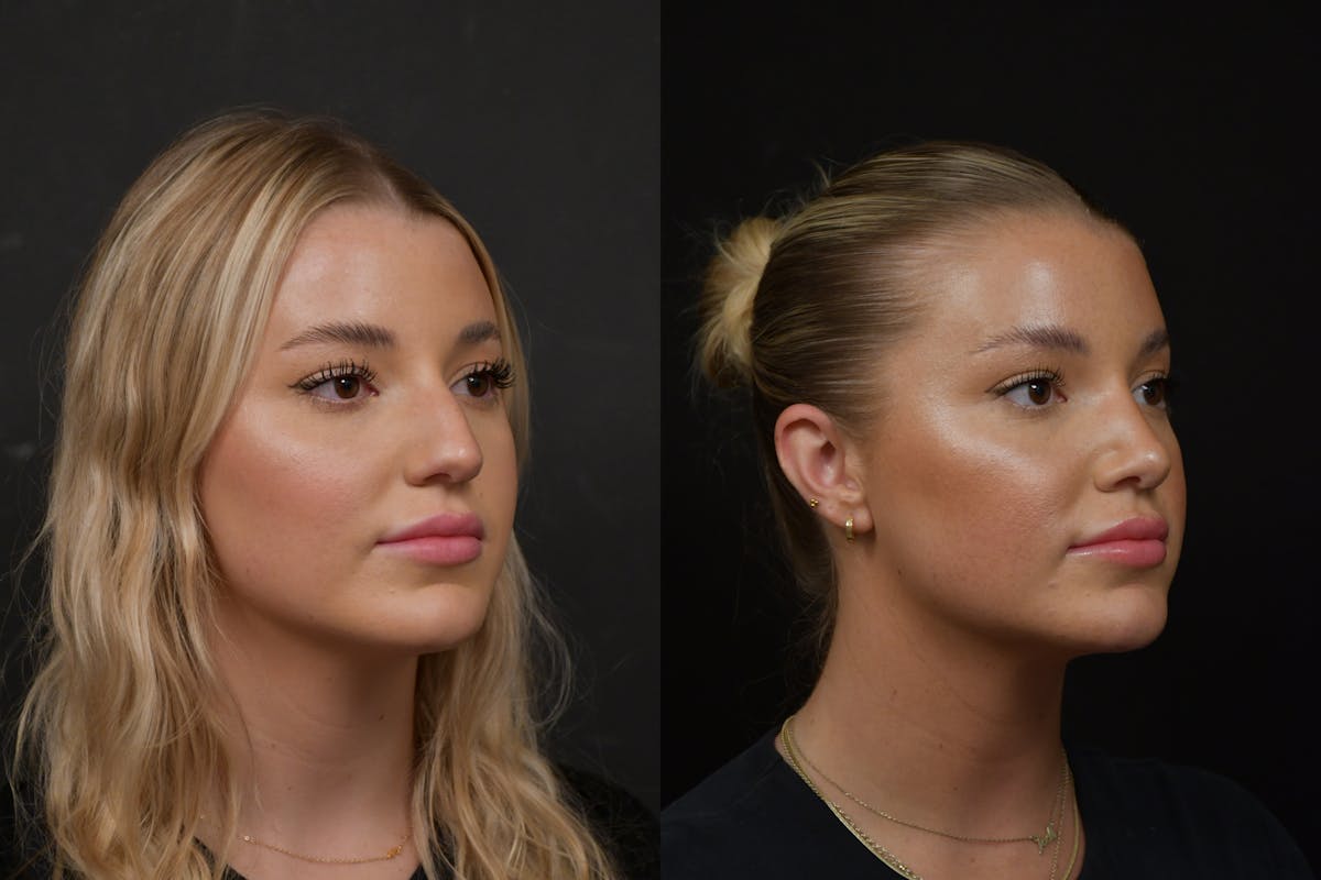 Rhinoplasty Before & After Gallery - Patient 317118 - Image 3