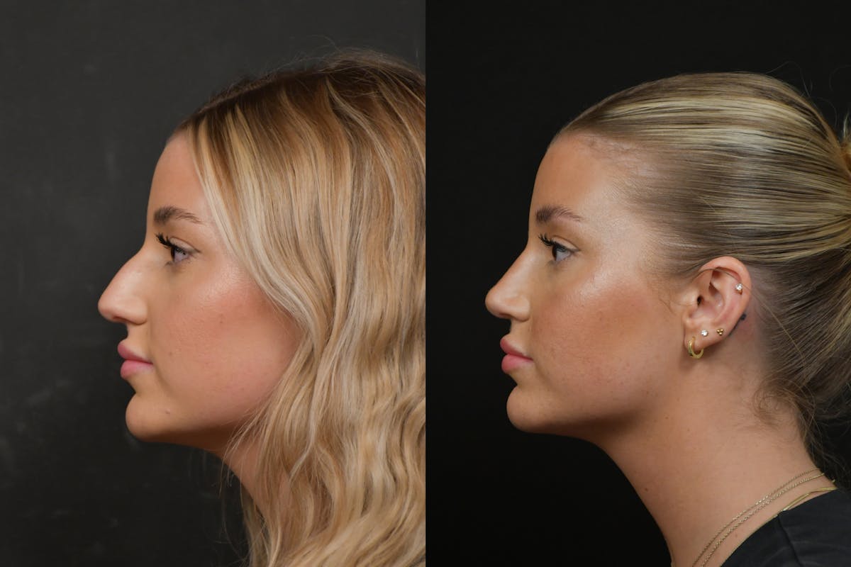 Rhinoplasty Before & After Gallery - Patient 317118 - Image 2