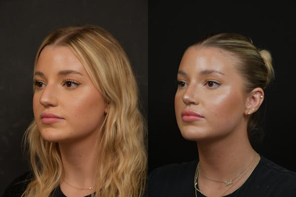 Rhinoplasty Before & After Gallery - Patient 317118 - Image 1