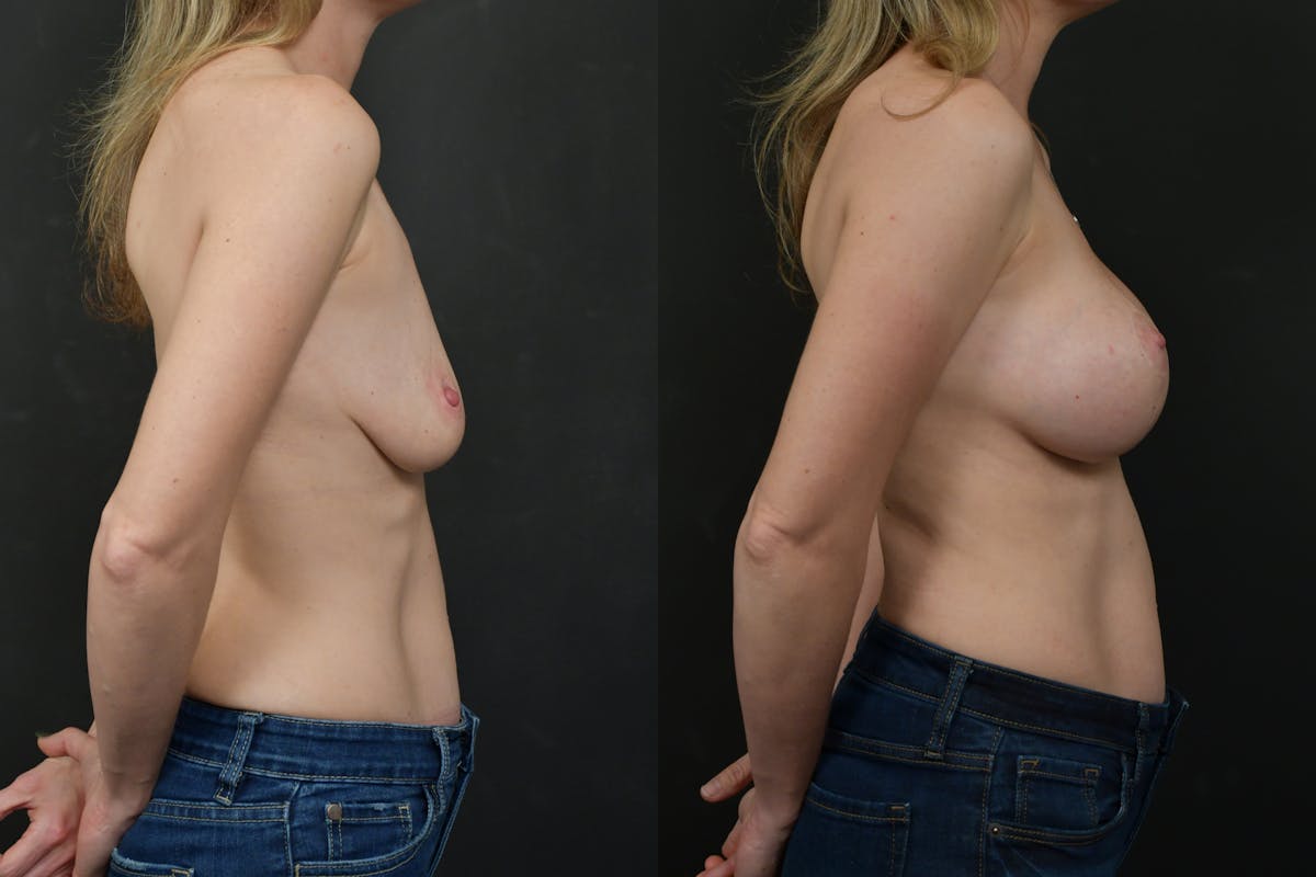 Breast Lift Before & After Gallery - Patient 175345 - Image 3