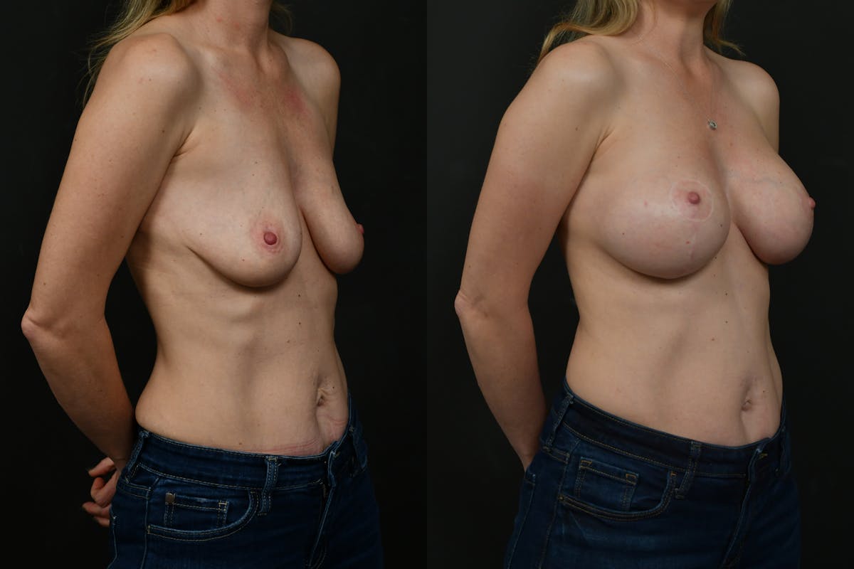 Breast Lift Before & After Gallery - Patient 175345 - Image 2