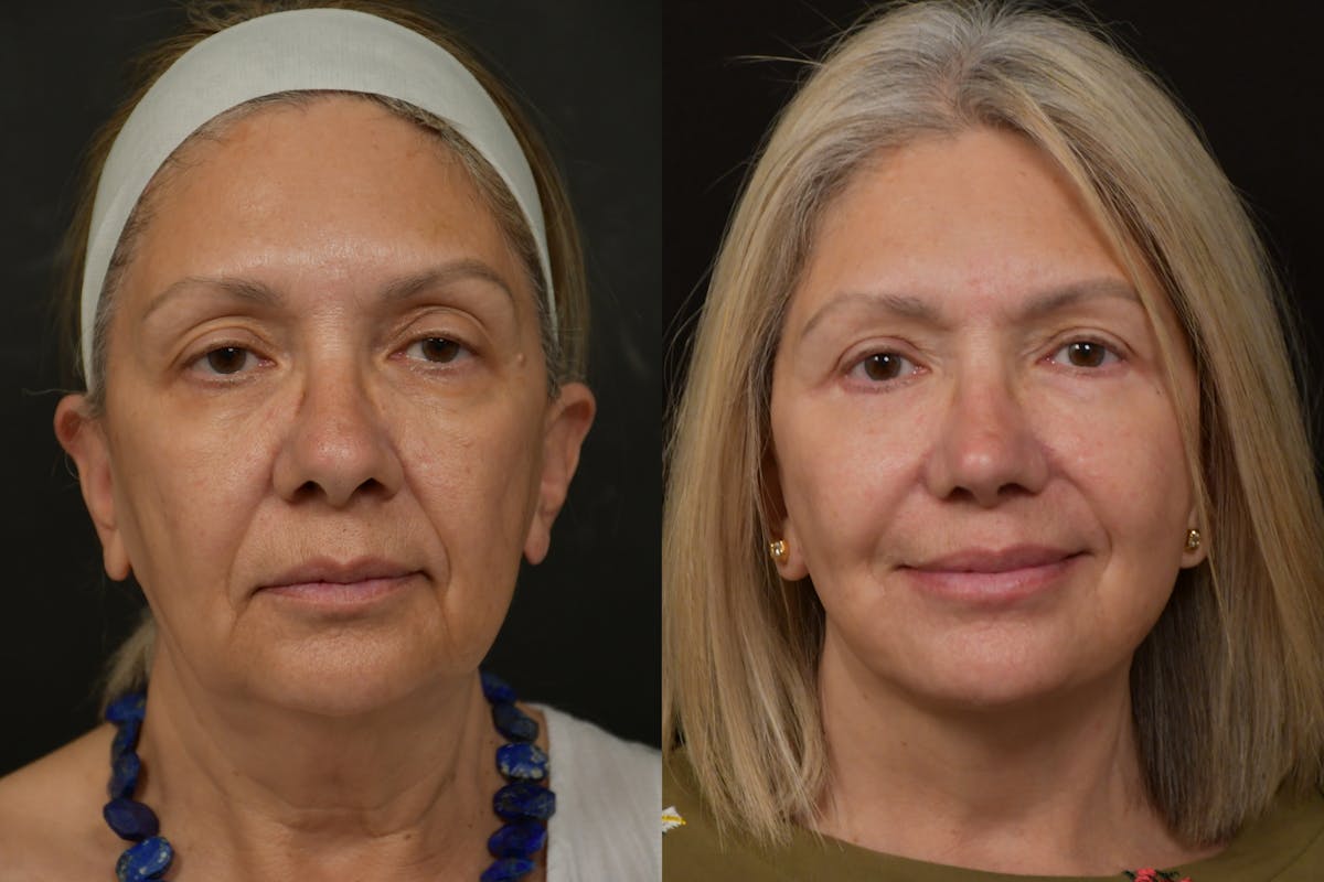 Changes Rapid Lift  Before & After Gallery - Patient 263705 - Image 5