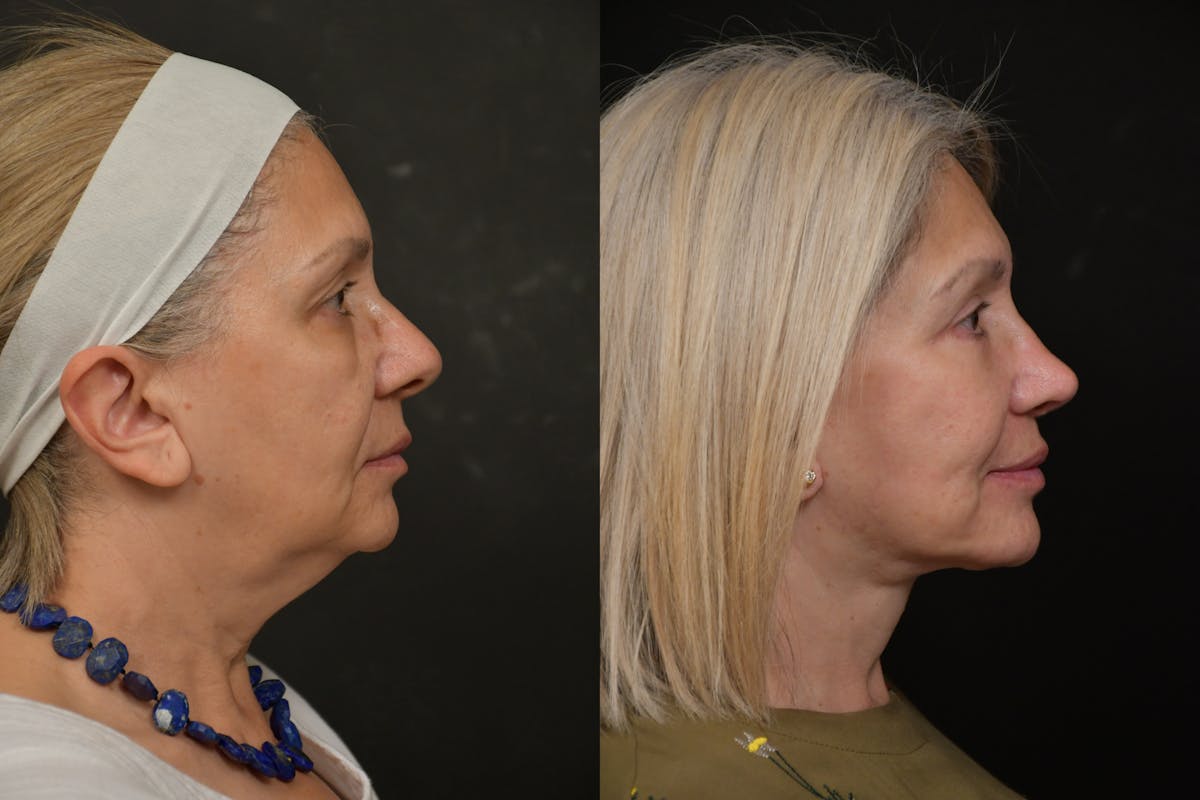 Changes Rapid Lift  Before & After Gallery - Patient 263705 - Image 4