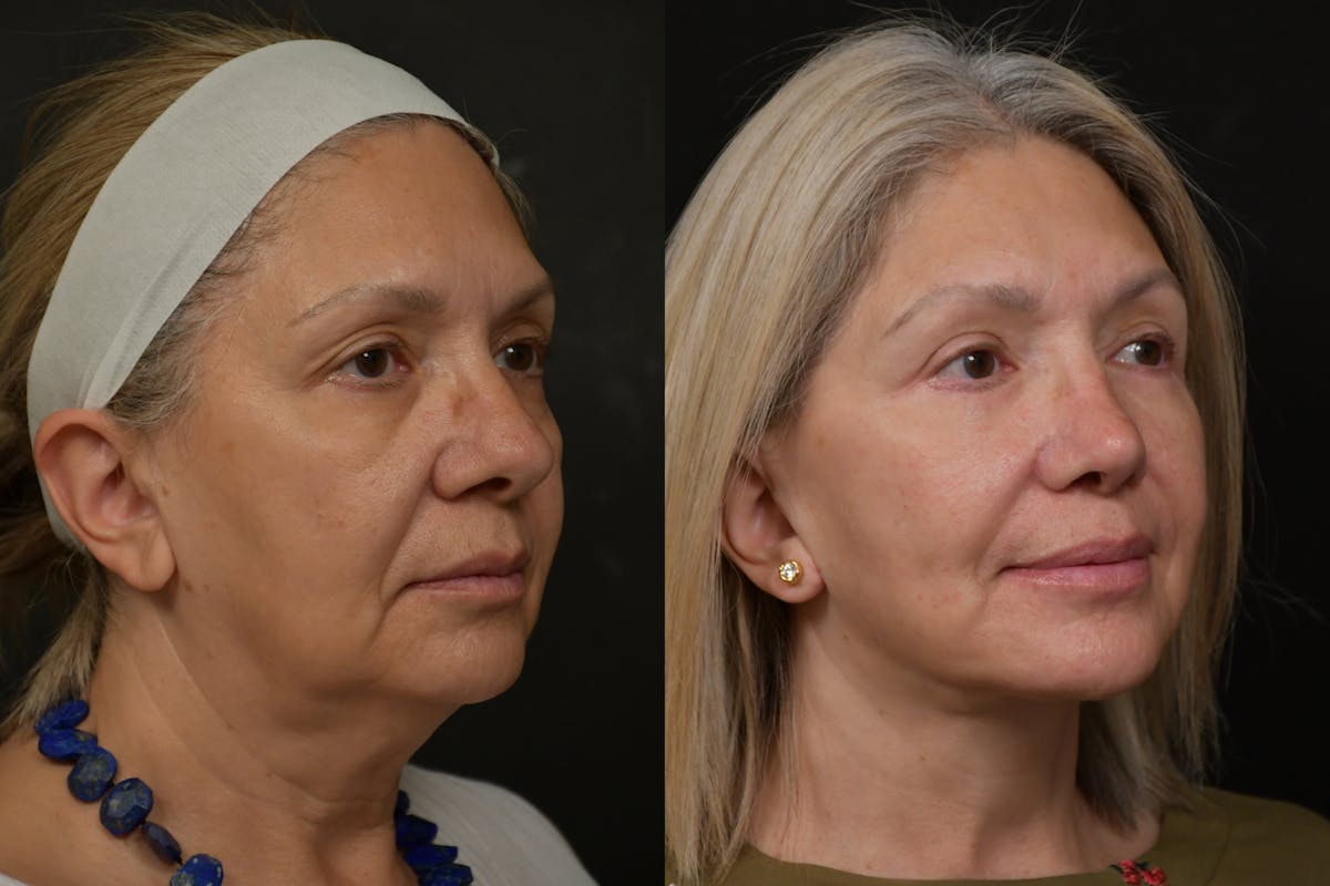 Changes Rapid Lift  Before & After Gallery - Patient 263705 - Image 3