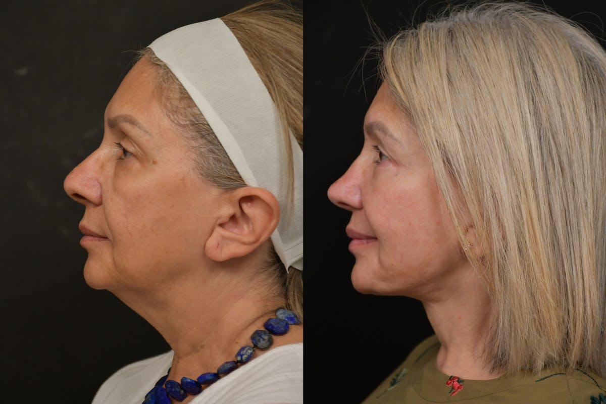 Changes Rapid Lift  Before & After Gallery - Patient 263705 - Image 2